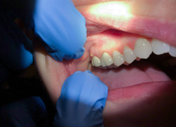 Best Broken or Chipped Tooth Repair in Perry, OH